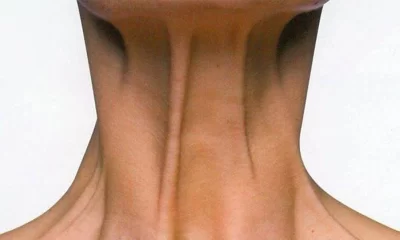 حقن البوتوكس للرقبة: شباب بلا جراحة